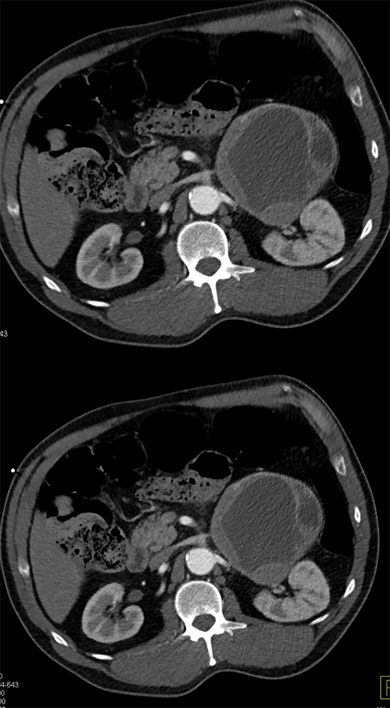 Adrenal Pheochromocytoma