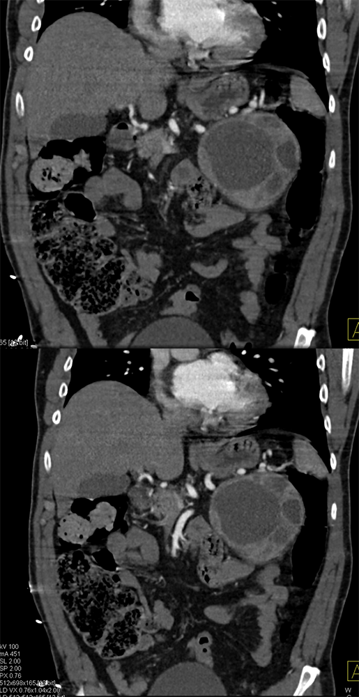 Adrenal Pheochromocytoma