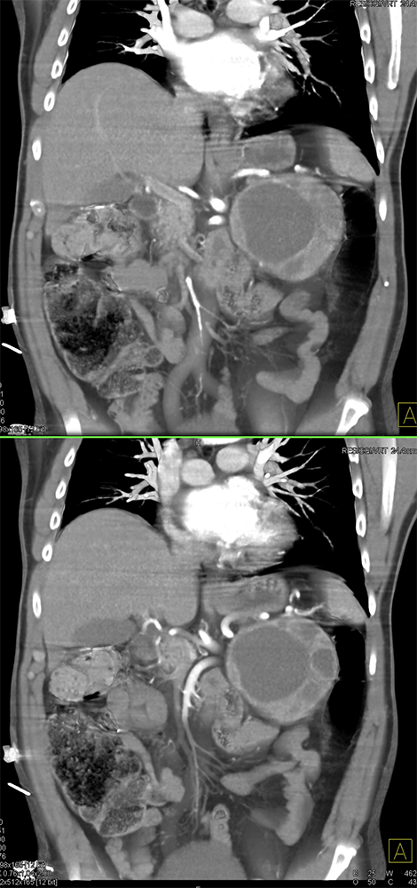 Adrenal Pheochromocytoma