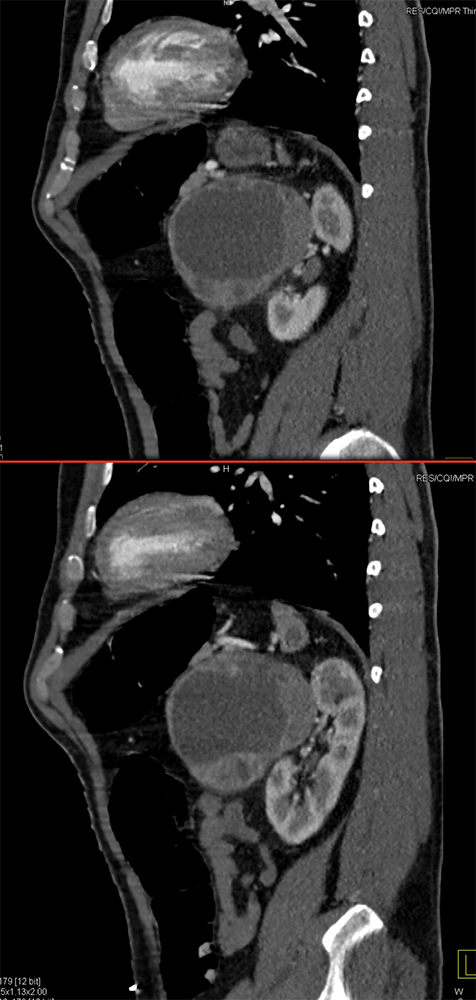 Adrenal Pheochromocytoma