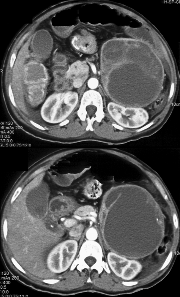 Incidental Pheochromocytoma