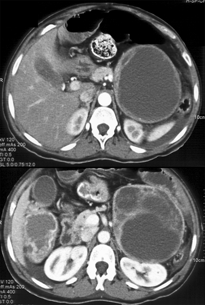 Adrenal Pheochromocytoma