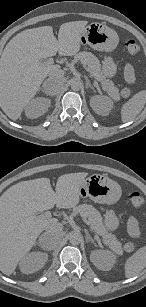 Pheochromocytoma