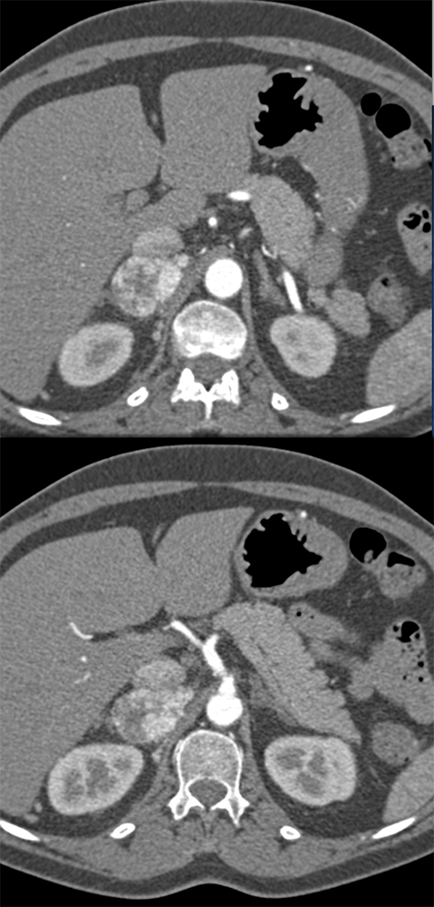 Adrenal Pheochromocytoma