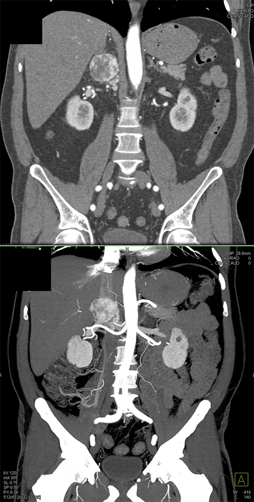 Adrenal Pheochromocytoma