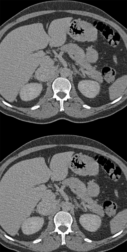 Adrenal Pheochromocytoma