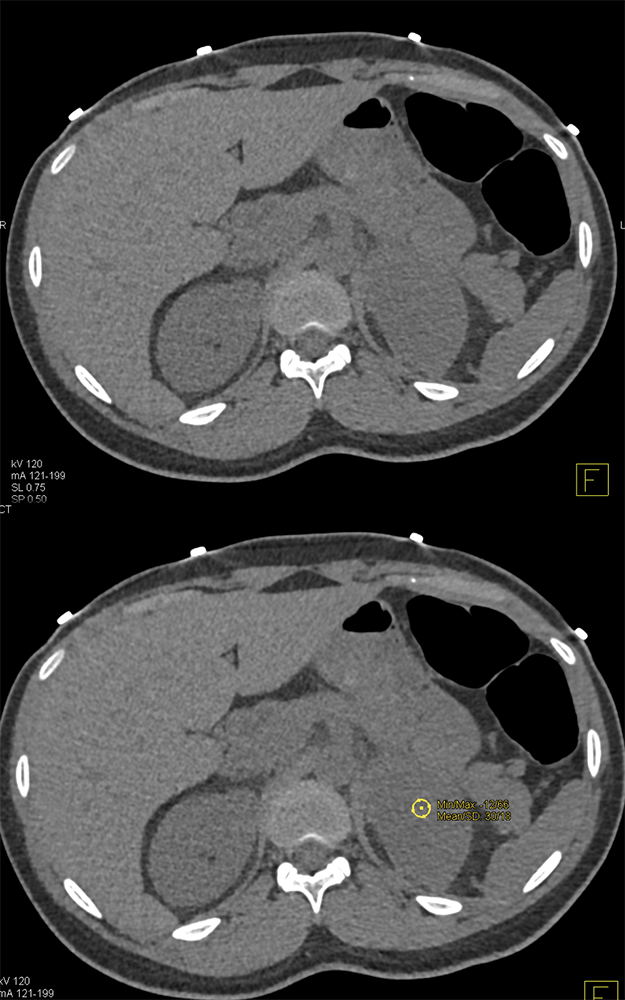 Pheochromocytoma