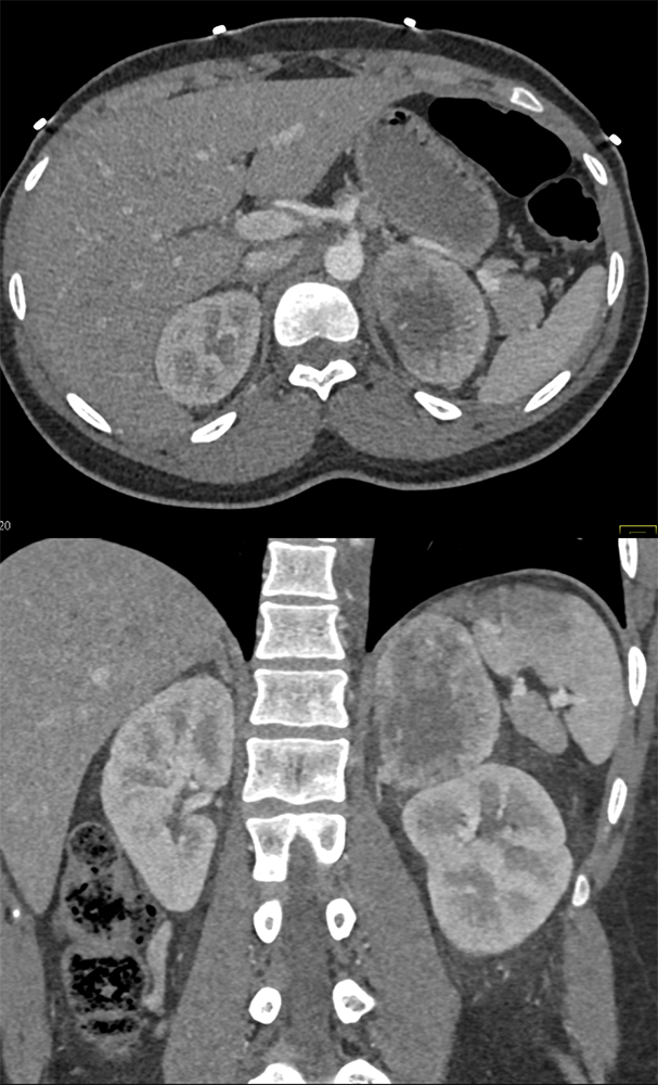 Adrenal Pheochromocytoma