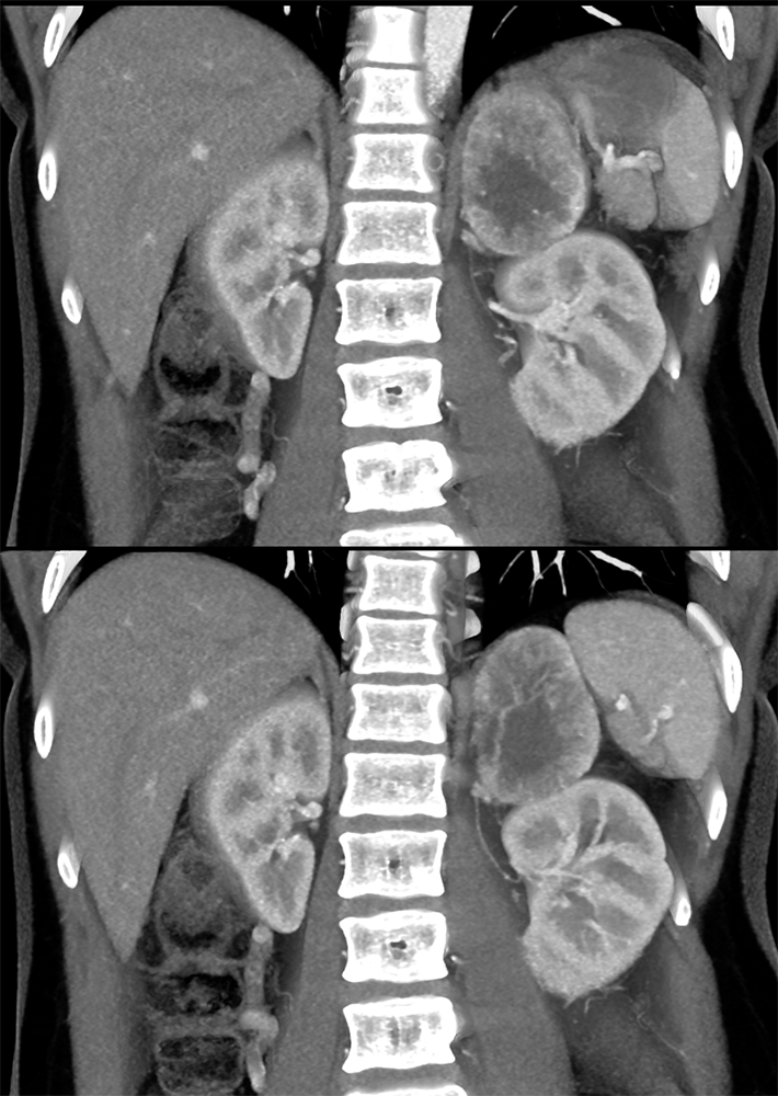 Adrenal Pheochromocytoma