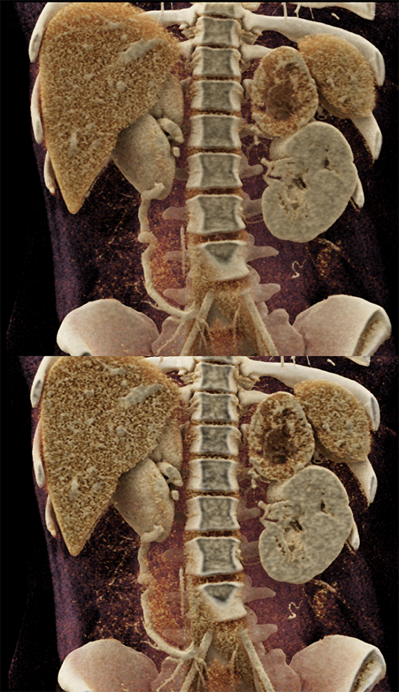 Adrenal Pheochromocytoma