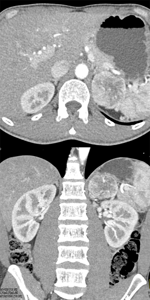 Pheochromcytoma