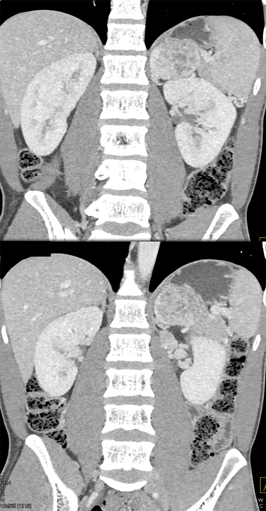 Adrenal Pheochromocytoma