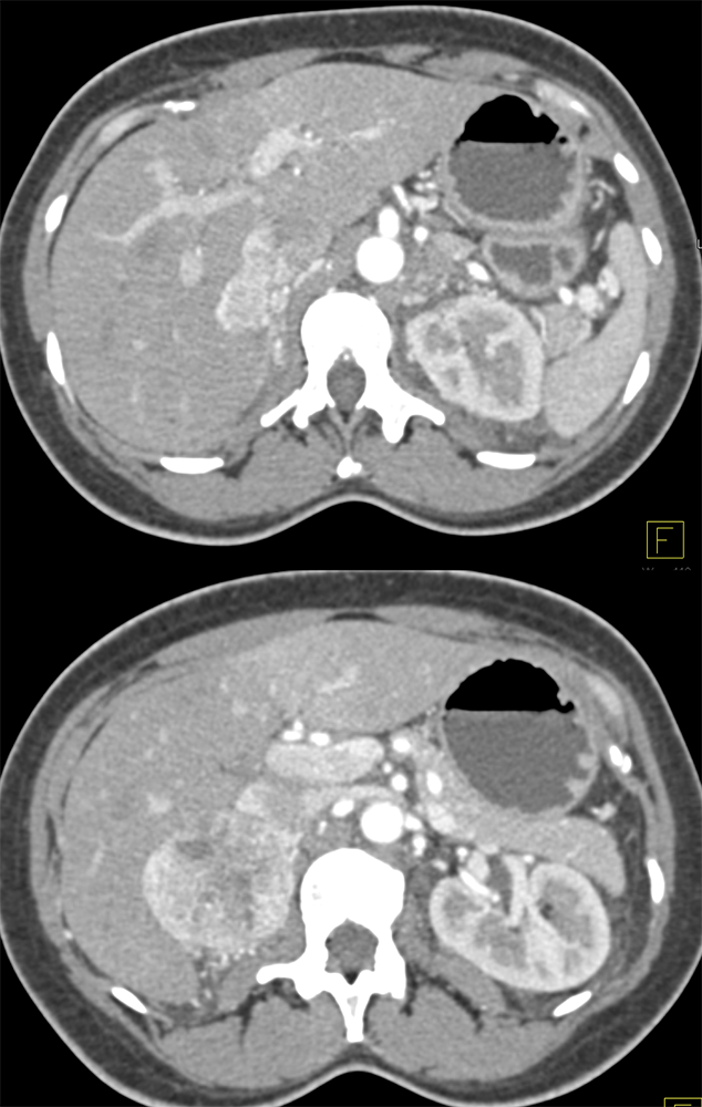 Pheochromocytoma