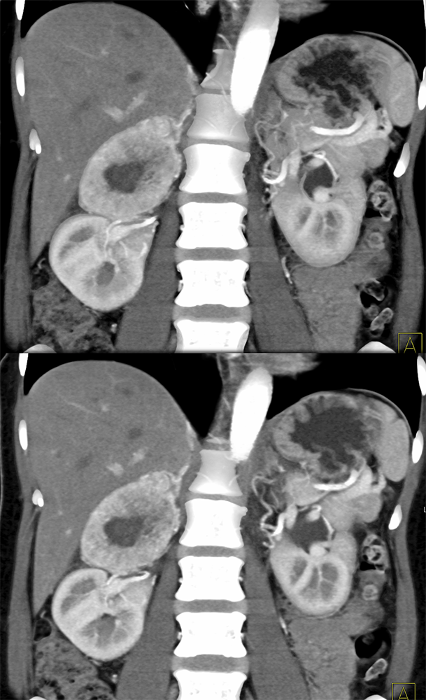 Adrenal Pheochromocytoma