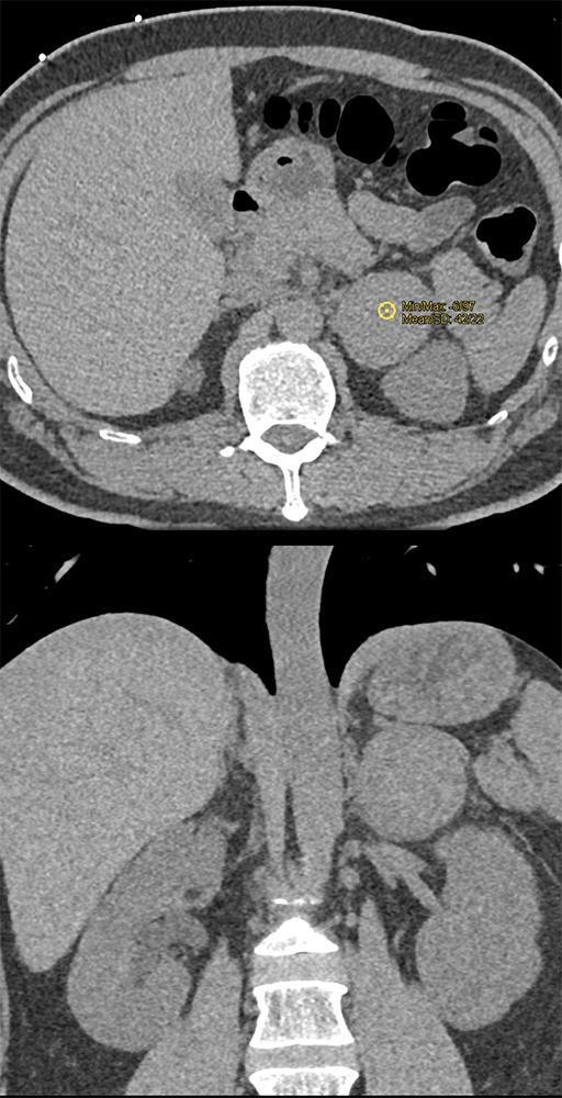 Adrenal Pheochromocytoma