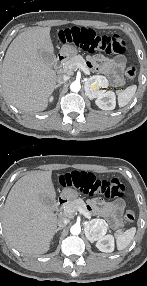 Adrenal Pheochromocytoma