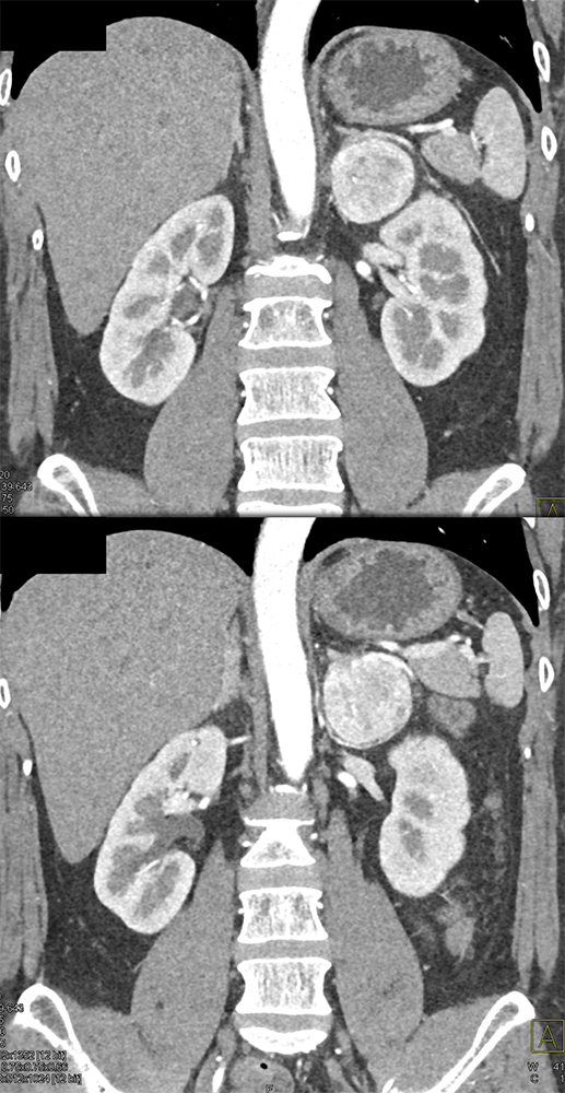 Adrenal Pheochromocytoma