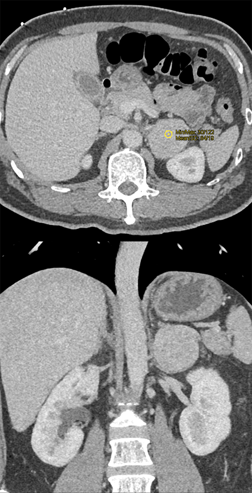 Adrenal Pheochromocytoma