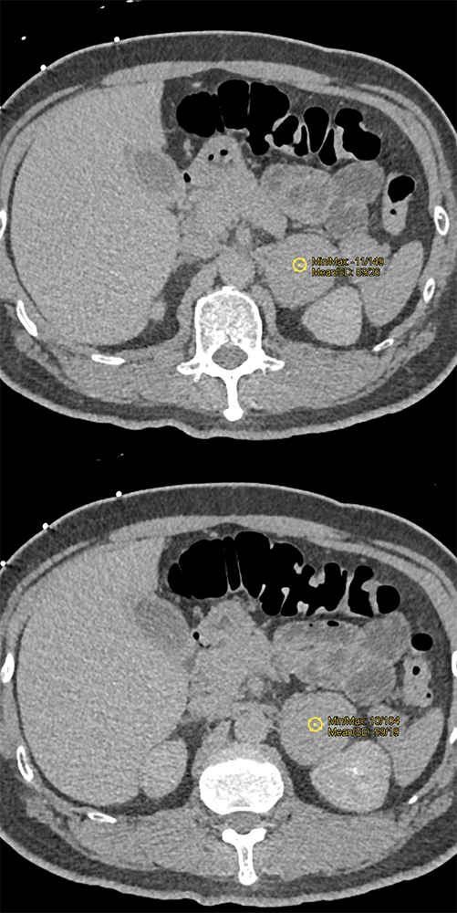 Adrenal Pheochromocytoma