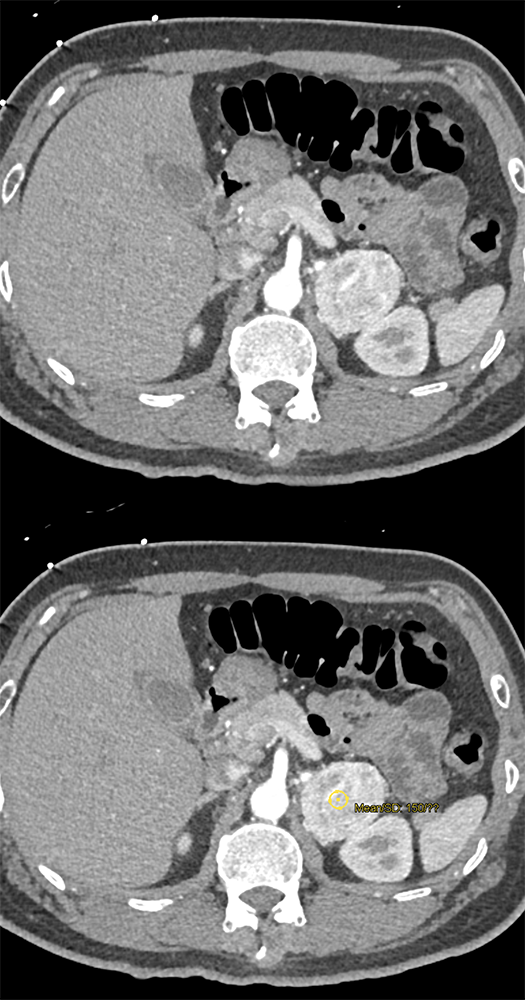 Pheochromocytoma