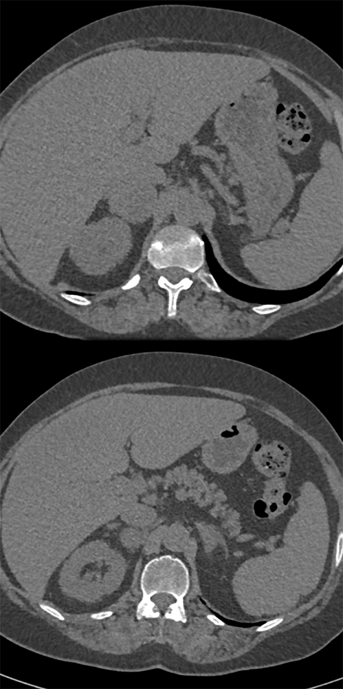 5cm Pheo Adrenal Gland