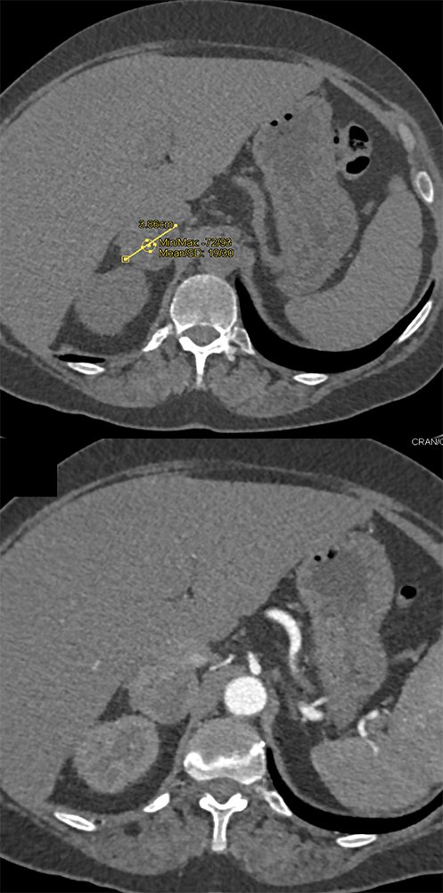 Adrenal Pheochromocytoma