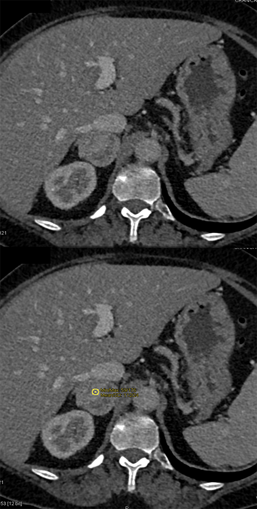 Adrenal Pheochromocytoma