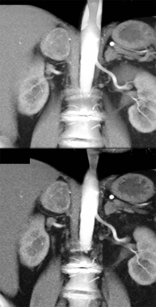 Adrenal Pheochromocytoma