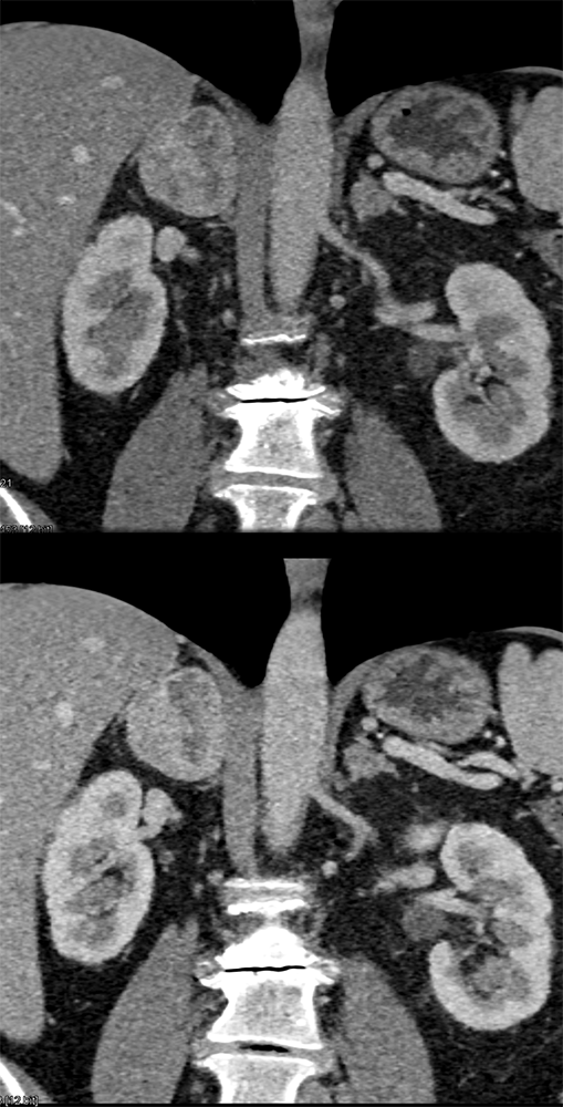 Adrenal Pheochromocytoma