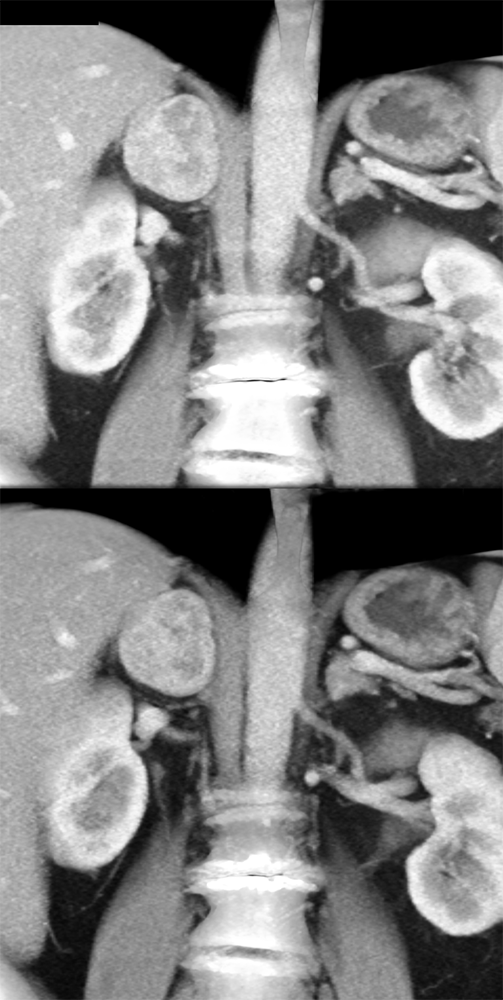 Adrenal Pheochromocytoma