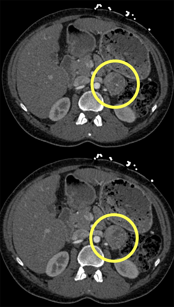 Incidental Pheochromocytoma