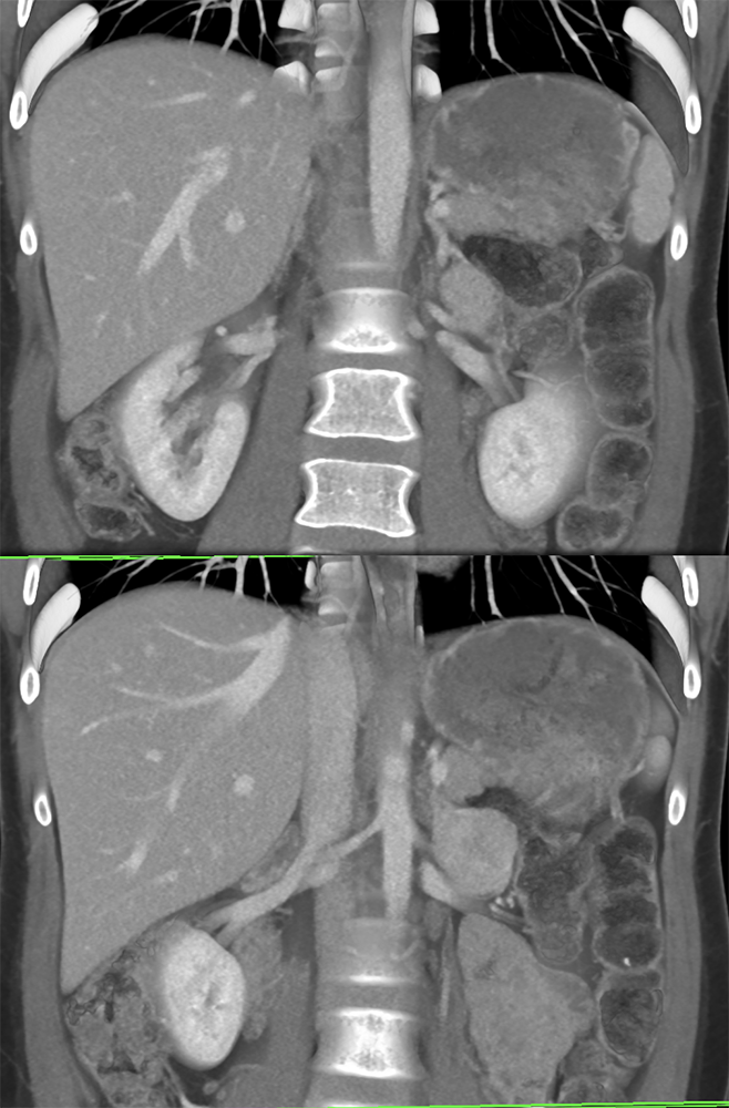 Adrenal Pheochromocytoma