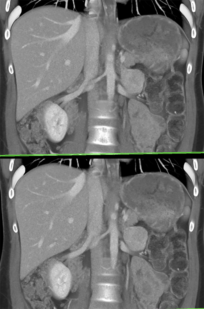 Adrenal Pheochromocytoma