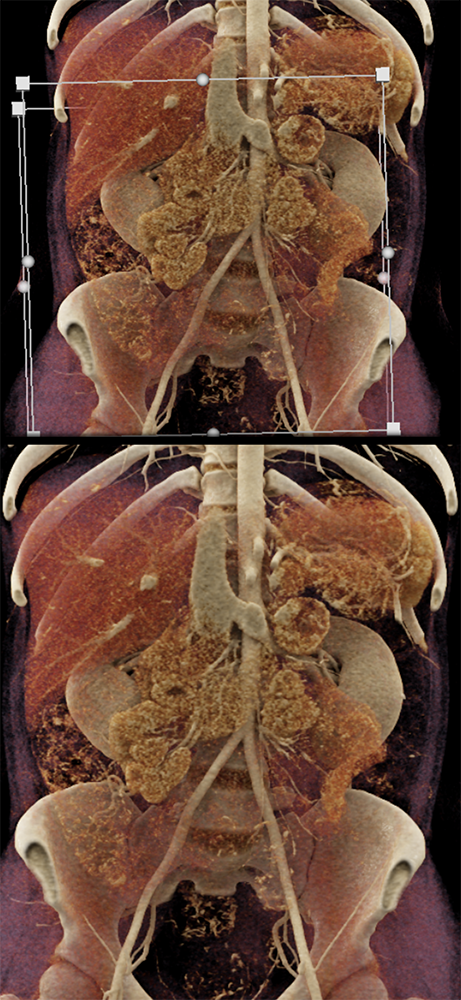 Adrenal Pheochromocytoma