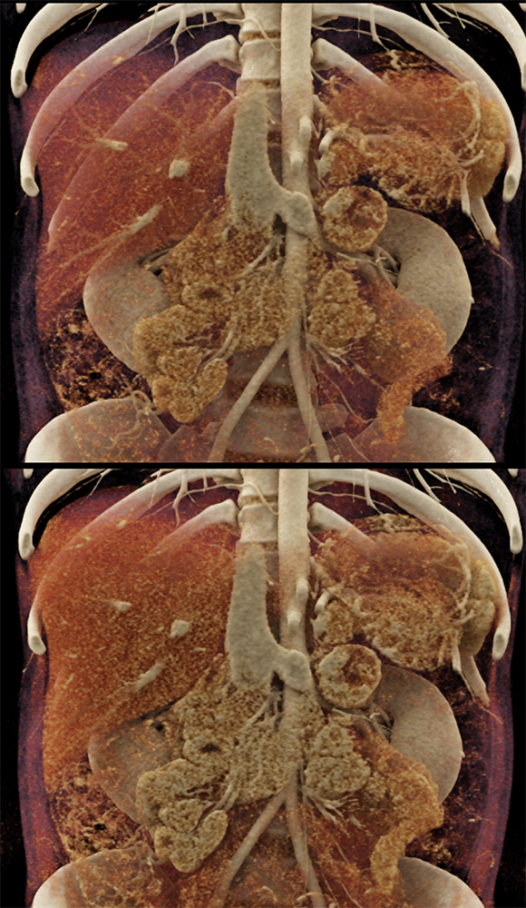 Adrenal Pheochromocytoma