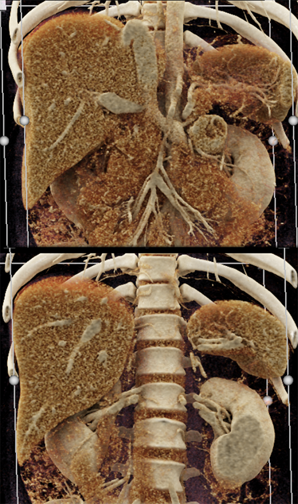 Adrenal Pheochromocytoma