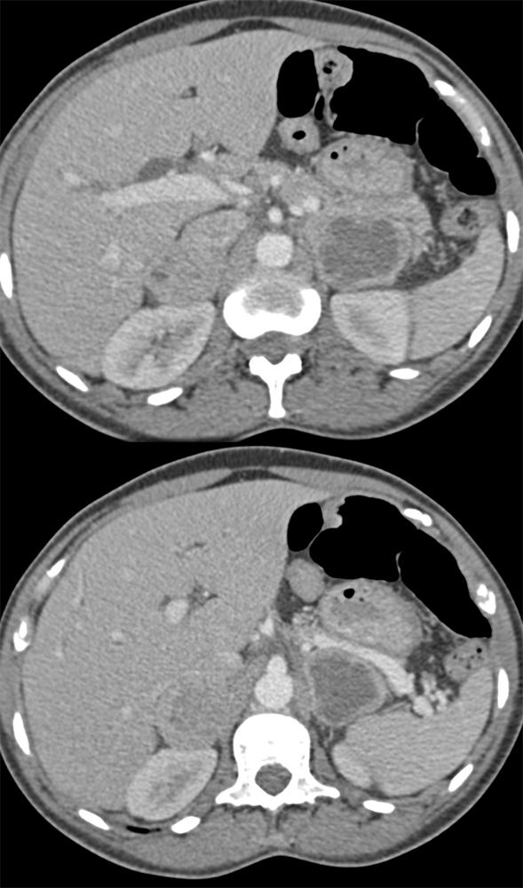 Bilateral Pheochromocytomas (hx of Neurofibromatosis)