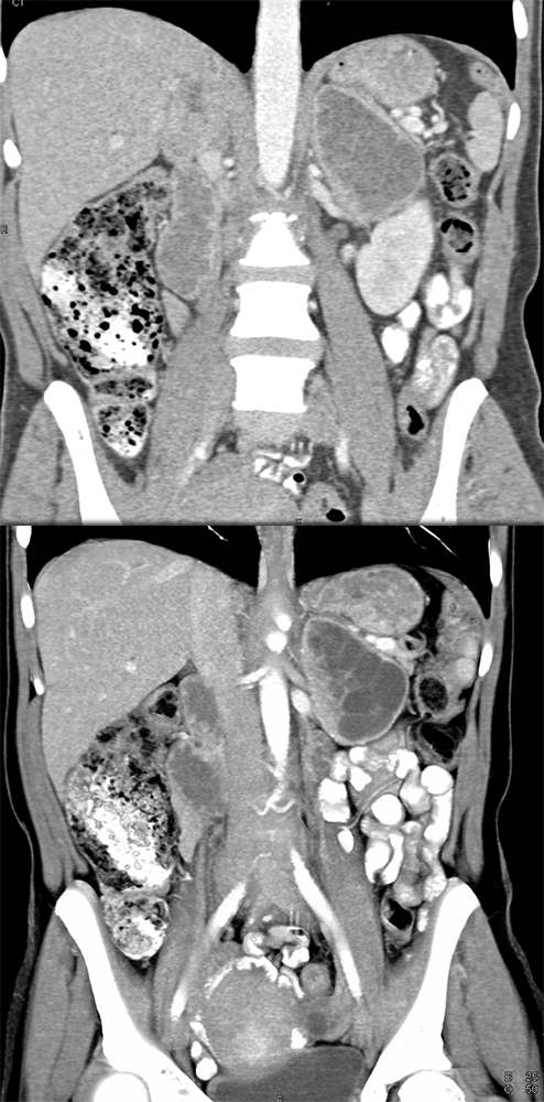 Adrenal Pheochromocytoma