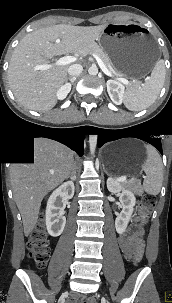 Adrenal Pheochromocytoma