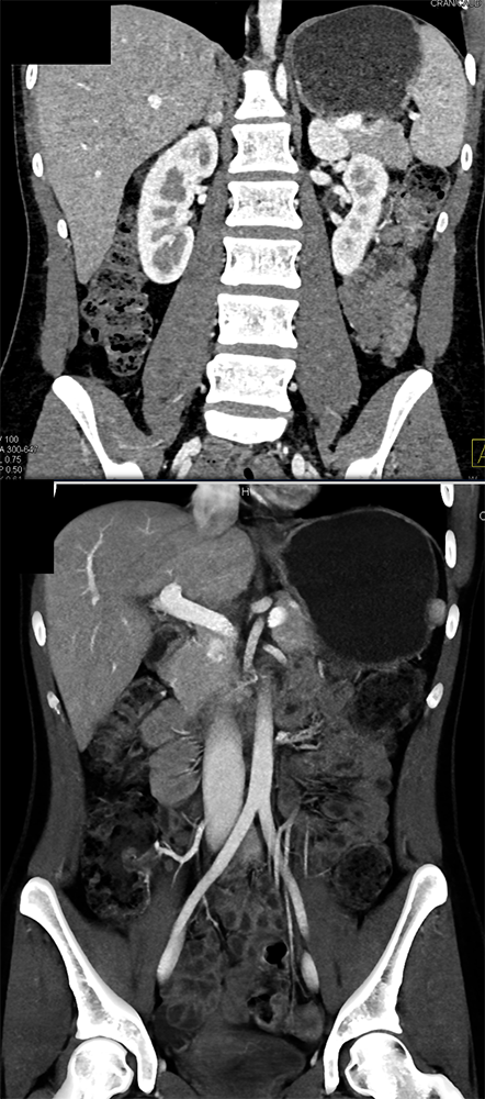 Adrenal Pheochromocytoma