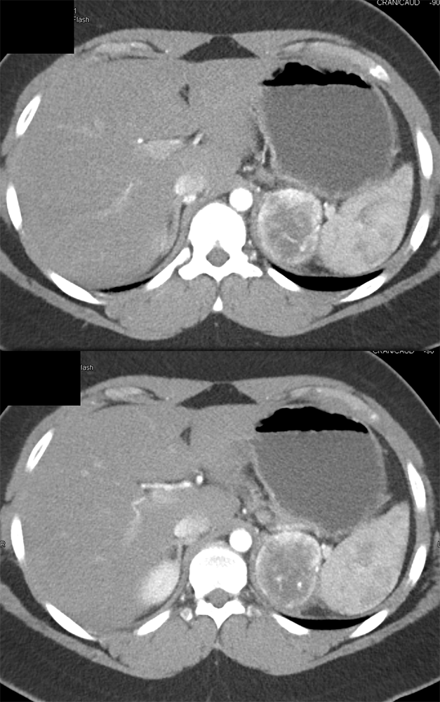 VHL with Bilateral Pheo and Bilateral RCCs and Age 22