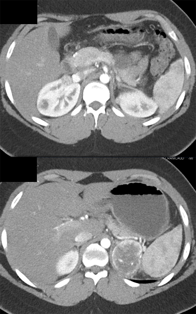 Adrenal Pheochromocytoma