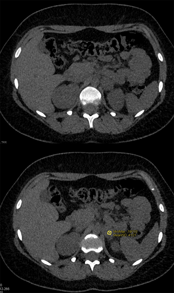 VHL with Bilateral Pheos in 18 Year Old Female