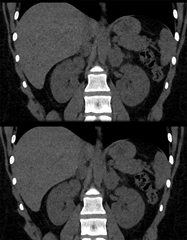 Adrenal Pheochromocytoma