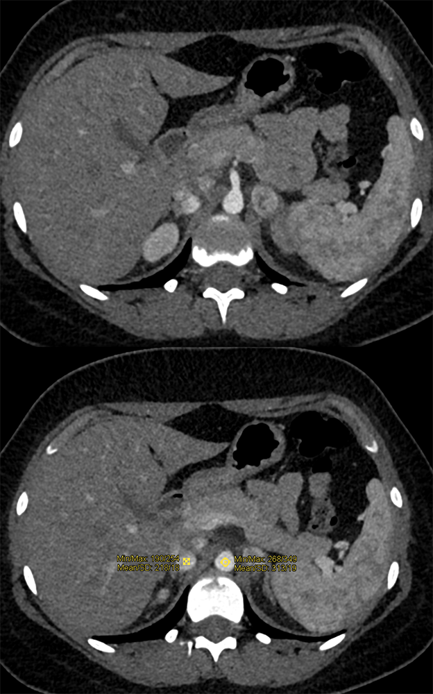 Adrenal Pheochromocytoma