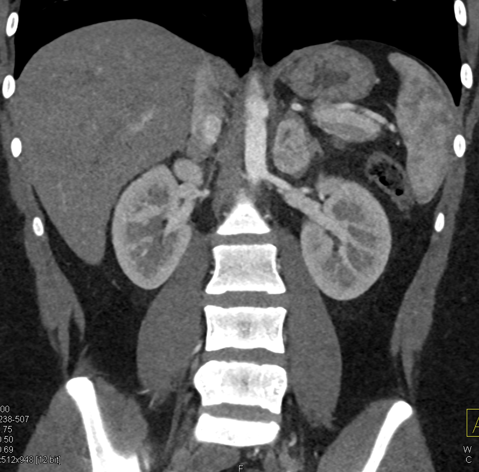 Adrenal Pheochromocytoma