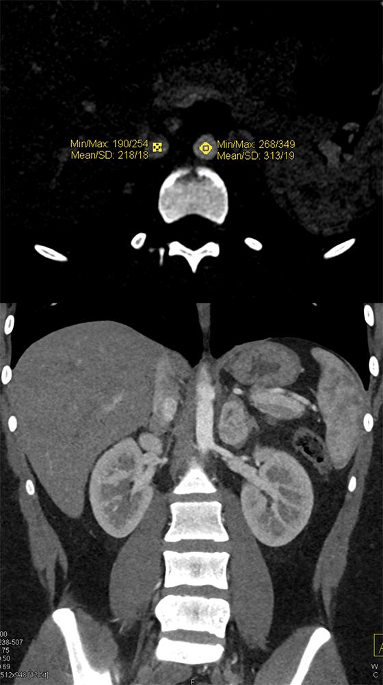 Adrenal Pheochromocytoma