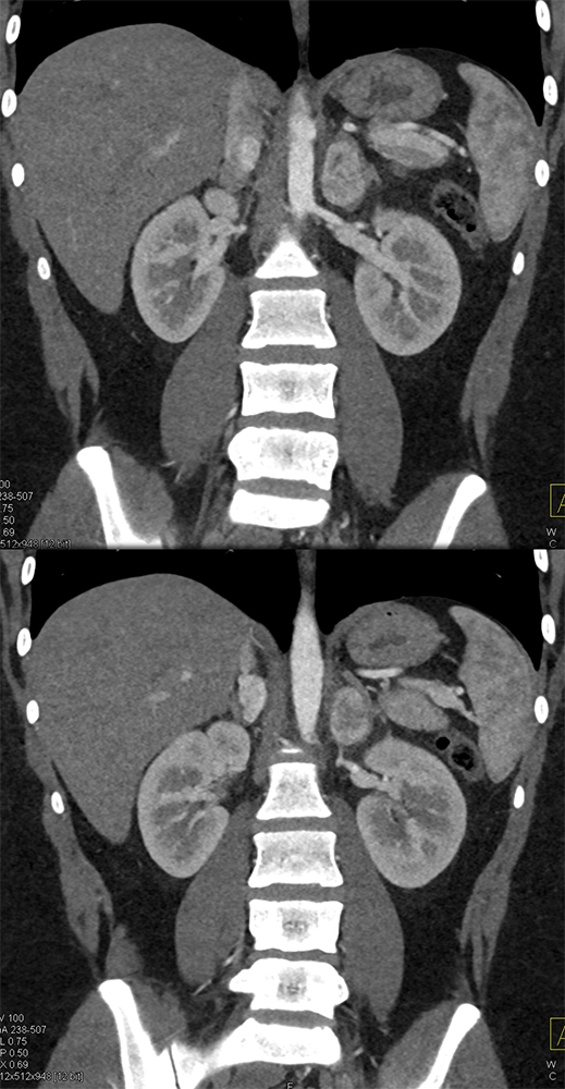 Adrenal Pheochromocytoma