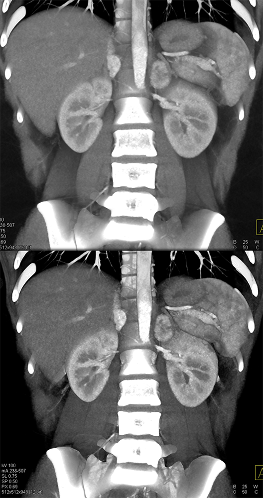 Adrenal Pheochromocytoma