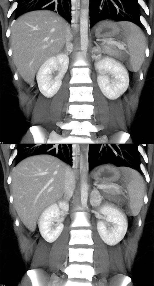 Adrenal Pheochromocytoma